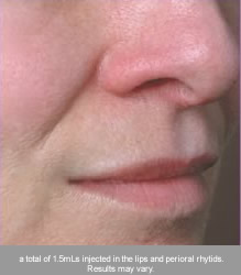 juvederm-volbella lip after